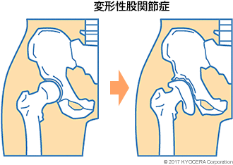 変形性股関節症