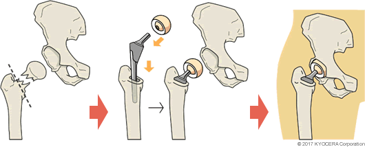 人工骨頭置換術の例