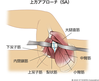 上方アプローチ（SA）