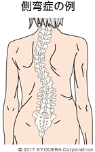 側弯症の例