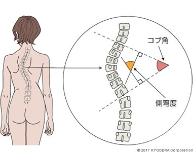 頂椎 コブ角 側弯度