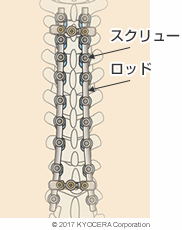 側弯症の手術