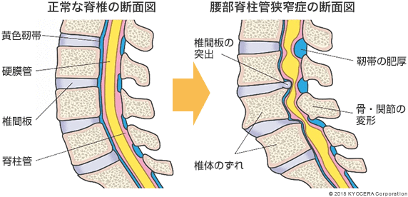 正常な脊椎の断面図 腰部脊柱管狭窄症の断面図