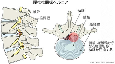 腰椎椎間板ヘルニア