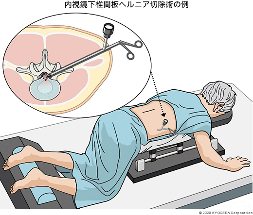 内視鏡下椎間板ヘルニア切除術の例