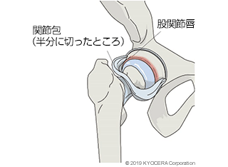 股関節唇 関節包（半分に切ったところ）