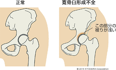 正常 寛骨臼形成不全