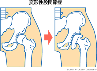 変形性股関節症