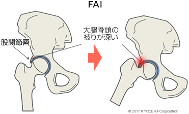 FAI 大腿骨頭の被りが深い