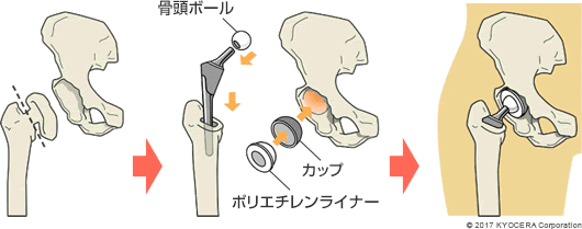 人工股関節置換術の例