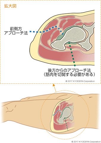 前側方アプローチ法