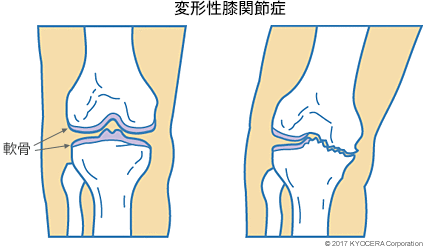 変形性膝関節症