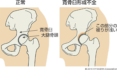 正常 寛骨臼形成不全