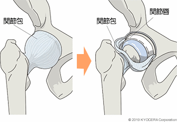 関節包 関節唇