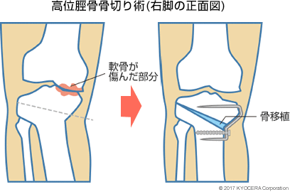 高位脛骨骨切り術(右脚の正面図)