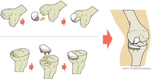 人工膝関節単顆置換術の例