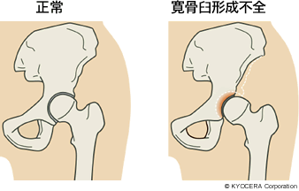 正常 寛骨臼形成不全