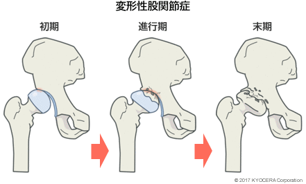変形性股関節症 初期 進行期 末期