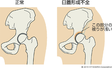 正常 臼蓋形成不全