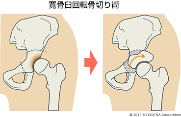 寛骨臼回転骨切り術