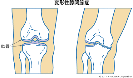 変形性膝関節症