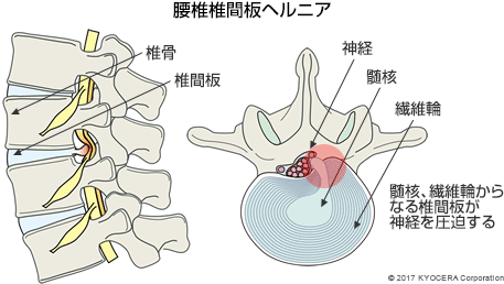 腰椎椎間板ヘルニア