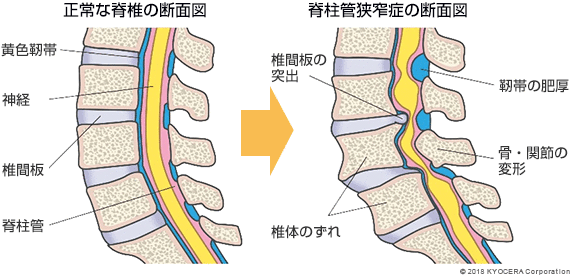 正常な脊椎の断面図 脊柱管狭窄症の断面図