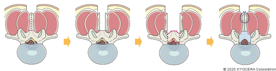椎弓切除術