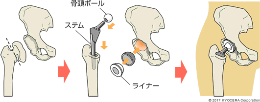 人工股関節置換術