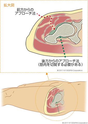 前方からのアプローチ法 後方からのアプローチ法（筋肉を切開する必要がある）