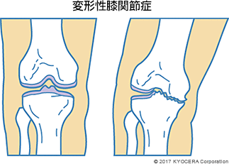 変形性膝関節症