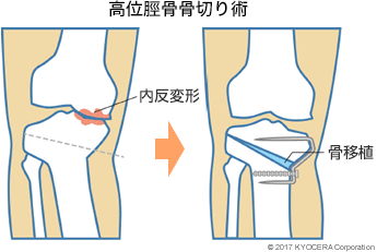 高位脛骨骨切り術