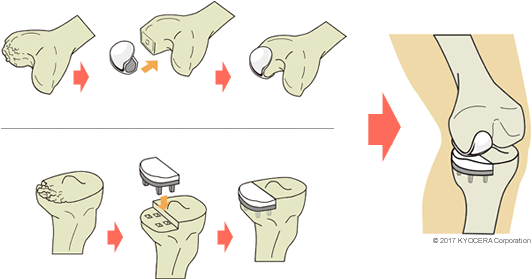 人工膝単顆置換術の例