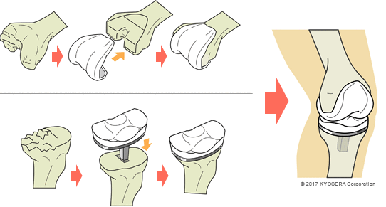 人工膝関節全置換術の例