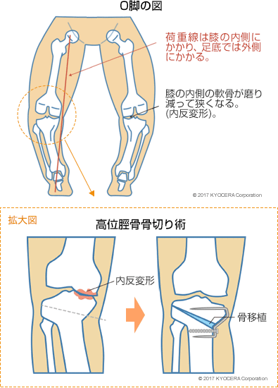 O脚の図 高位脛骨骨切り術