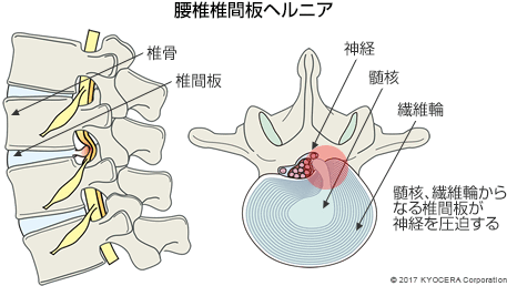 低侵襲手術 山川 知之 腰部脊柱管狭窄症や腰椎椎間板ヘルニアなどは 内視鏡を用いた低侵襲手術によって 早期に社会復帰ができます