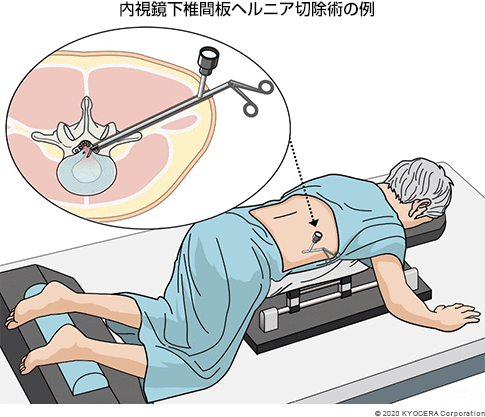 内視鏡下椎間板ヘルニア切除術の例
