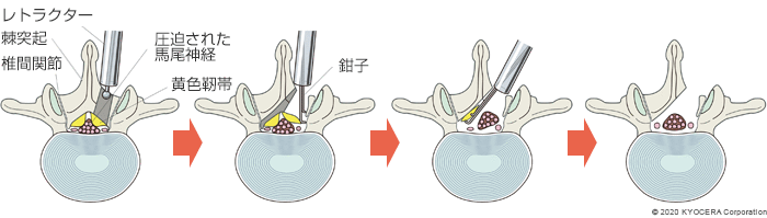 内視鏡下椎弓切除術（MEL）