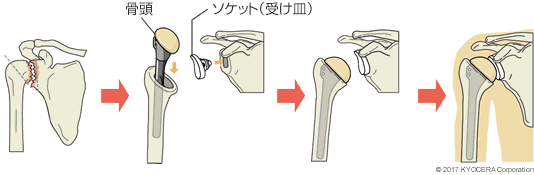 通常型の人工肩関節置換術