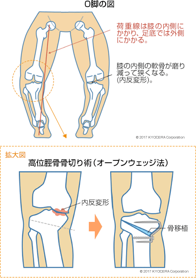 O脚の図 高位脛骨骨切り術（オープンウェッジ法）