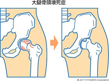 大腿骨頭壊死症