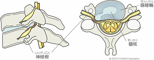 髄核 線維輪 神経根