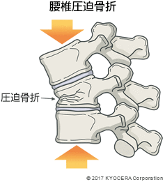 腰椎圧迫骨折