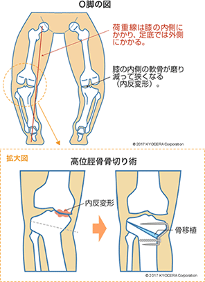 O脚の図