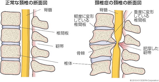 正常な頚椎の断面図 頚椎症の頚椎の断面図