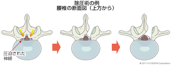 除圧術の例 腰椎の断面図（上方から）
