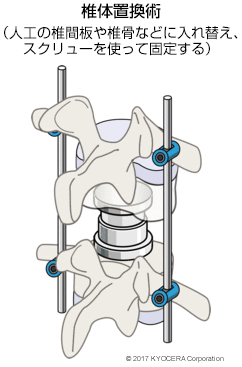 椎体置換術（⼈⼯の椎間板や椎骨などに⼊れ替え、スクリューを使って固定する）