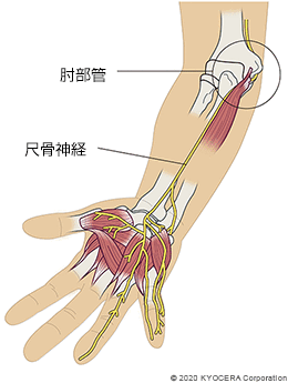 肘部管 尺骨神経