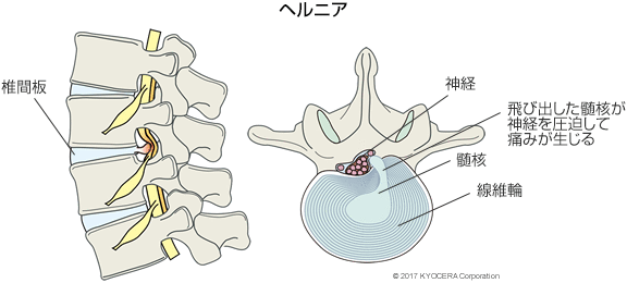 ヘルニア