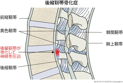 後縦靭帯骨化症